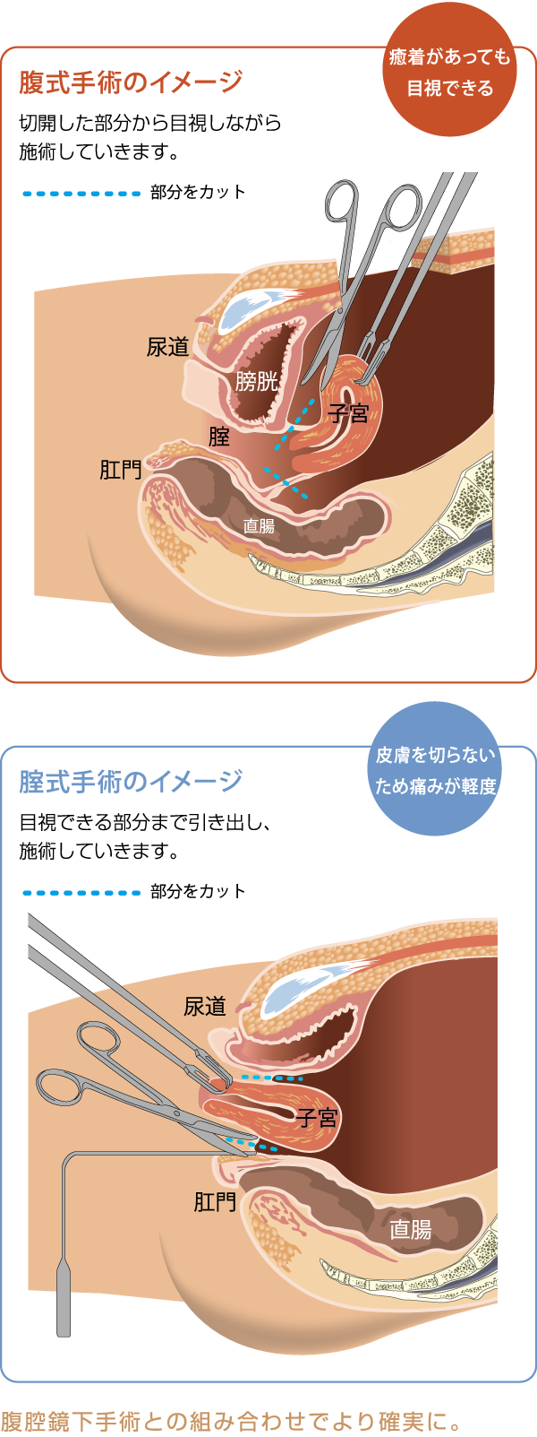 膣式子宮摘出手術 - 熊本市 | 産婦人科 無痛分娩 小児科 慈恵病院